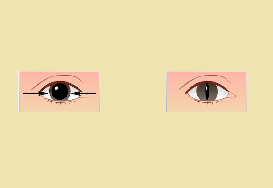 Что такое симптом кошачьего глаза